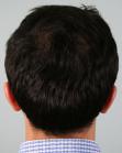 After Hair Transplant &nbsp;Crown
